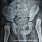 congenital-hip-dislocation-xray