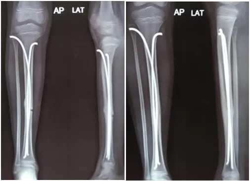 Children's Fracture