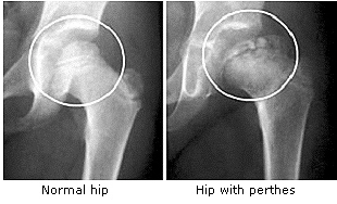Miscelleneous Pediatric Orthopedic Diseases