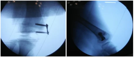 Bow Legs And Knock Knees