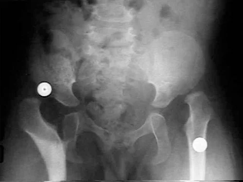 Congenital Hip Dislocation