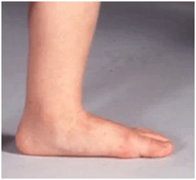 Flat Feet