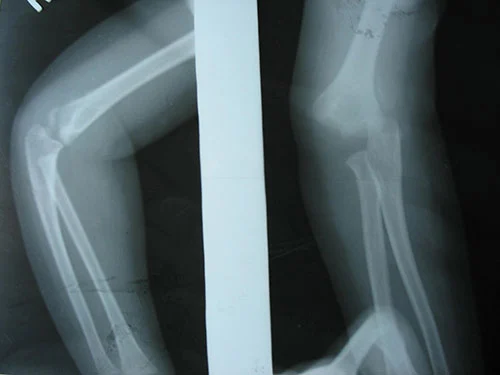 Neglected Fracture of Children