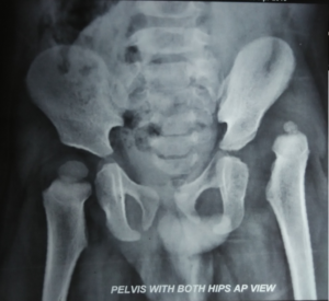 congenital-hip-dislocation-xray