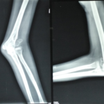 neglected fracture