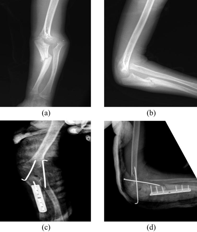 diagnose neglected fracture