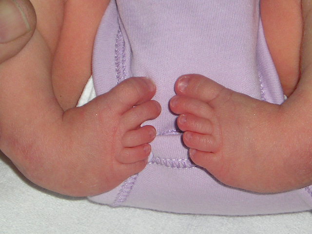 Clubfoot: Symptoms, Causes & Treatment