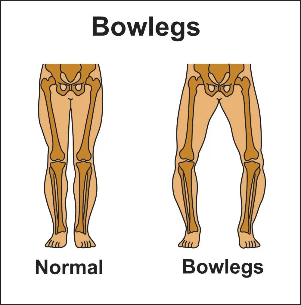 Causes Bow Legs