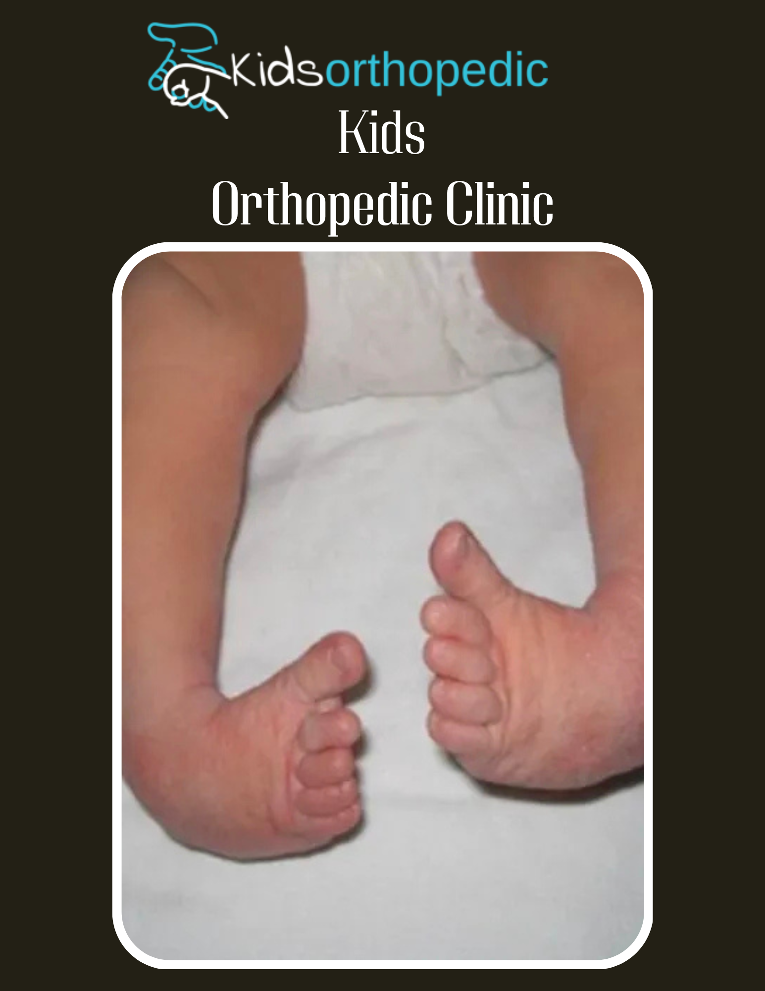 No Abortion in Clubfoot